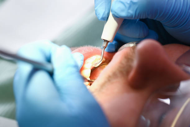 Best Emergency Dental Extractions in Huntington Beach, CA