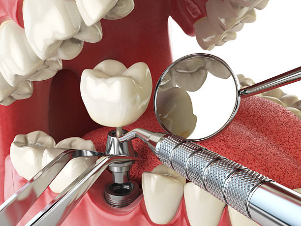 Best Emergency Dental Services for Seniors in Huntington Beach, CA